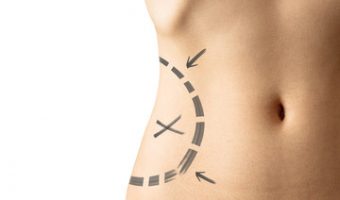 Costo Liposuzione Roma